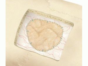 路过十八次: 浅析冠昊生物疝补片--可能是业绩