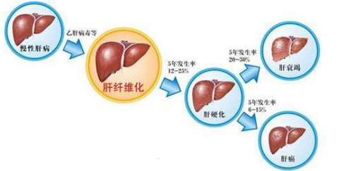 在肝纤维化早期阶段患者往往没有任何症状和体征,如果想实现早期诊断