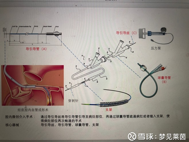 简单聊一下经皮冠状动脉介入治疗(pci)手术器械