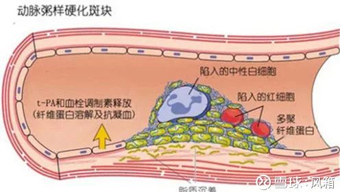 冠状动脉粥样硬化性心脏病25.1%