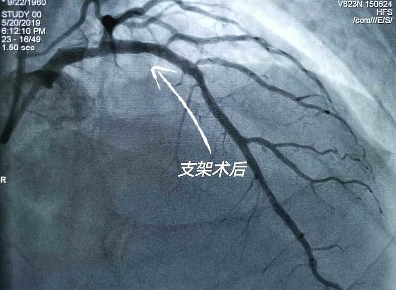 乐普医疗在北京完成第一例可降解冠脉支架的正式应用