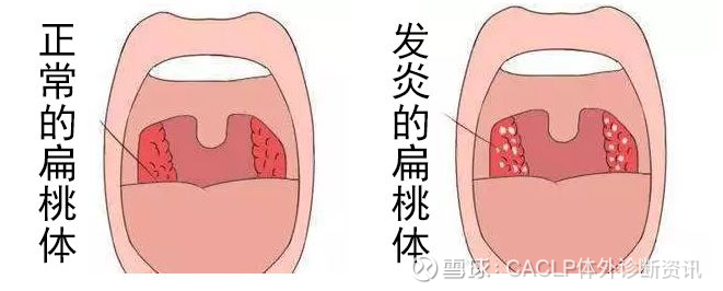 扁桃体恶性肿瘤多见于男性,男女比为2~3:1.