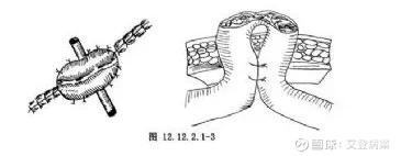 2.单腔造口