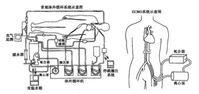 人工心肺机又称体外循环装置(extra corporeal circulation),主要