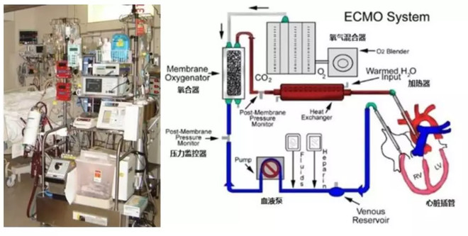 ecmo基本结构 套包又分为体外套包和体内穿刺套包.