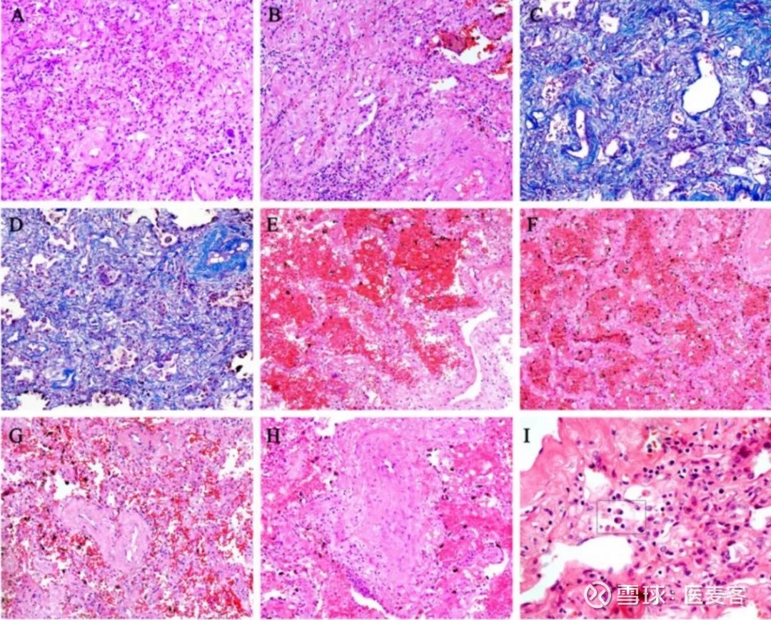 国际首例,新冠病毒肺炎危重症患者病理活检报道,为深入了解新冠肺炎