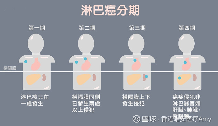 一文看懂各类癌症的分期