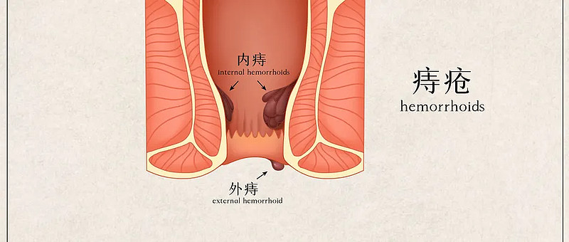 关于痔疮的几点真相,早知道少受罪