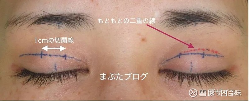 基本不肿,术后眼睛的开合非常自然,几乎没有左右差,三层眼皮也消失了
