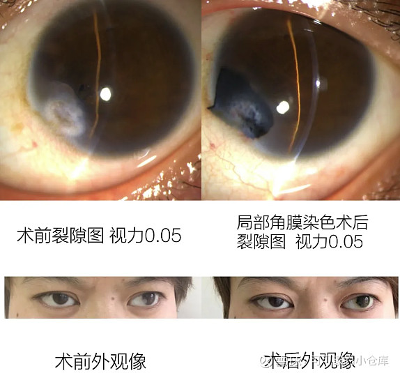 兰州爱尔科普你听说过角膜染色吗