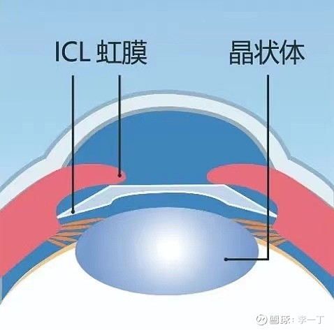 将icl晶体放置在眼后房,位于虹膜与晶状体之间.