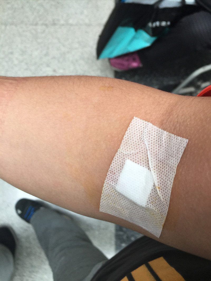 五月腰部扭伤第一天不能下床后针灸五天扎好而后不小心又扭了再次五天