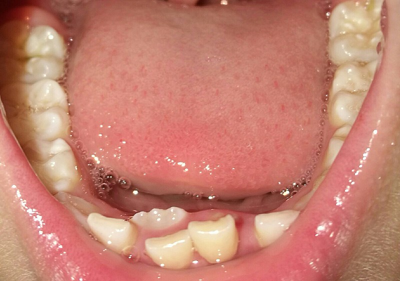 我儿子下面两颗门牙乳牙松动,恒牙的一颗门牙长在乳牙内侧,请问这个要