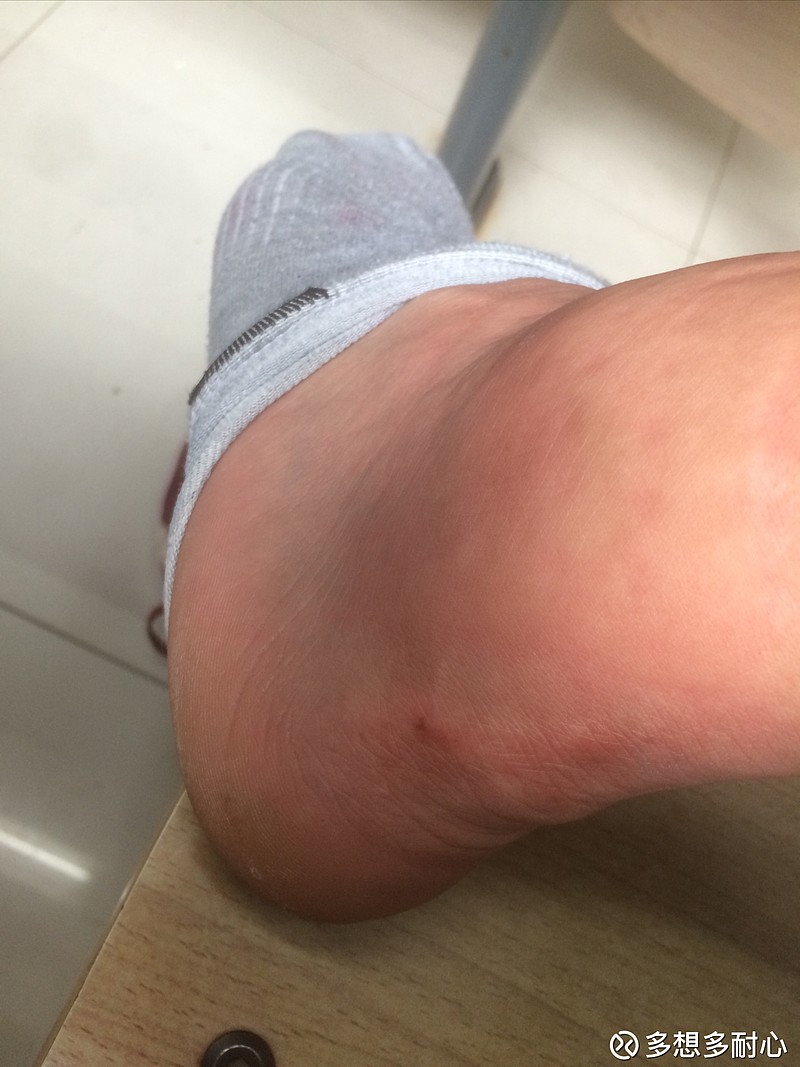 脚踝贴膏药要过敏手上贴云南白药创可贴也要过敏切记切记,贴了往往达