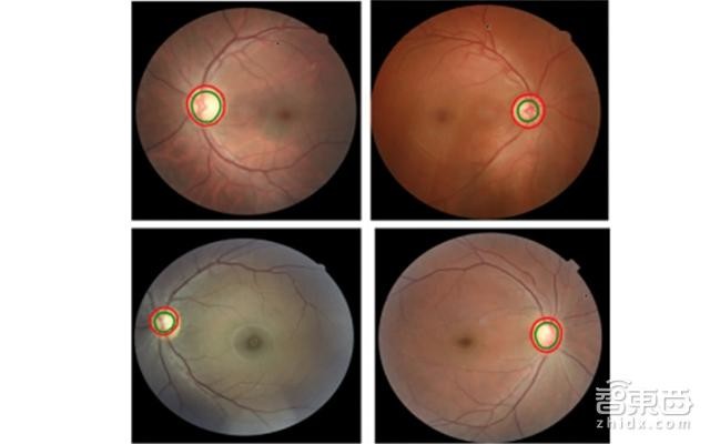 (图上显示的是四张眼球的背面图,watson 检测视杯及视盘的大小.
