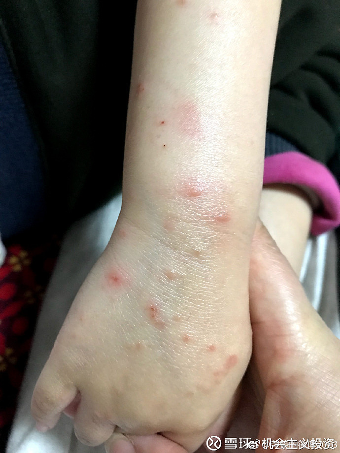 关于湿疹与荨麻疹最近有个好友得了皮肤病 一个医院诊断是湿疹 一个医院诊断是荨麻疹 最后问了我这个久病成医的 我也说不清 查了半天就查到这