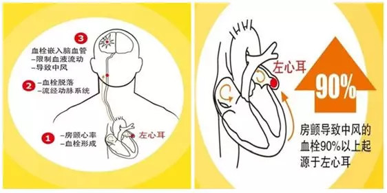 左心耳位置图片