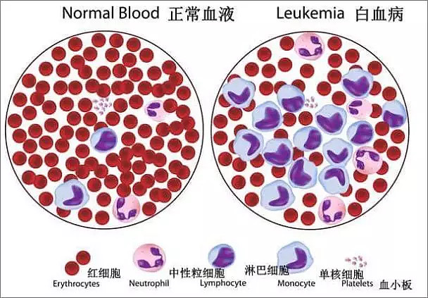 转:中国爷爷用蜡烛木板战胜最凶险急性杀人白血病!