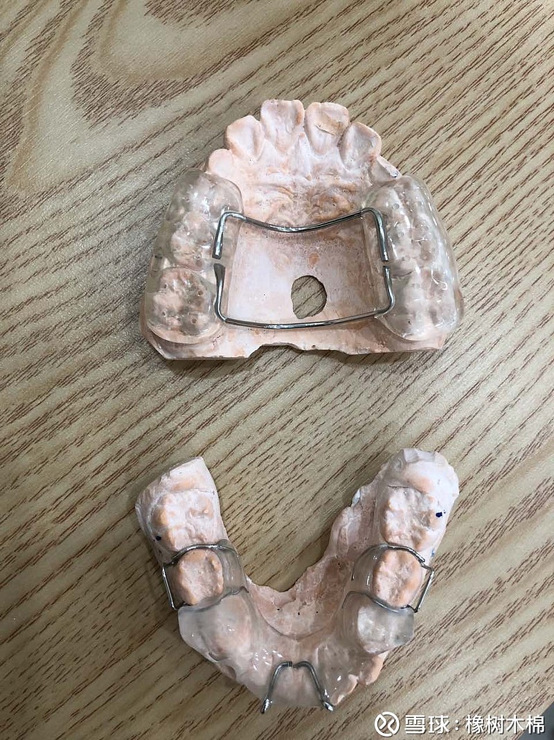 小朋友的导下颌向前矫正器卡住上下牙齿让下颌骨退不回去