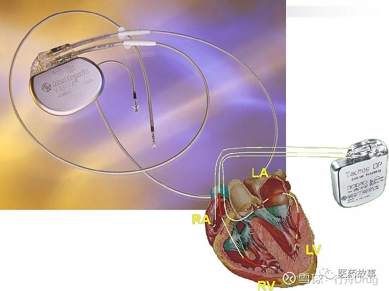 三腔起搏器 植入图片