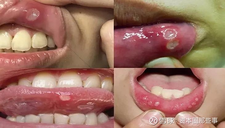 口腔溃疡界的印度神药3秒止痛24小时愈合还能健齿去口臭
