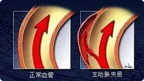 主动脉瘤指主动脉局部异常扩张变形(超过正常血管直径的 50%),呈瘤样