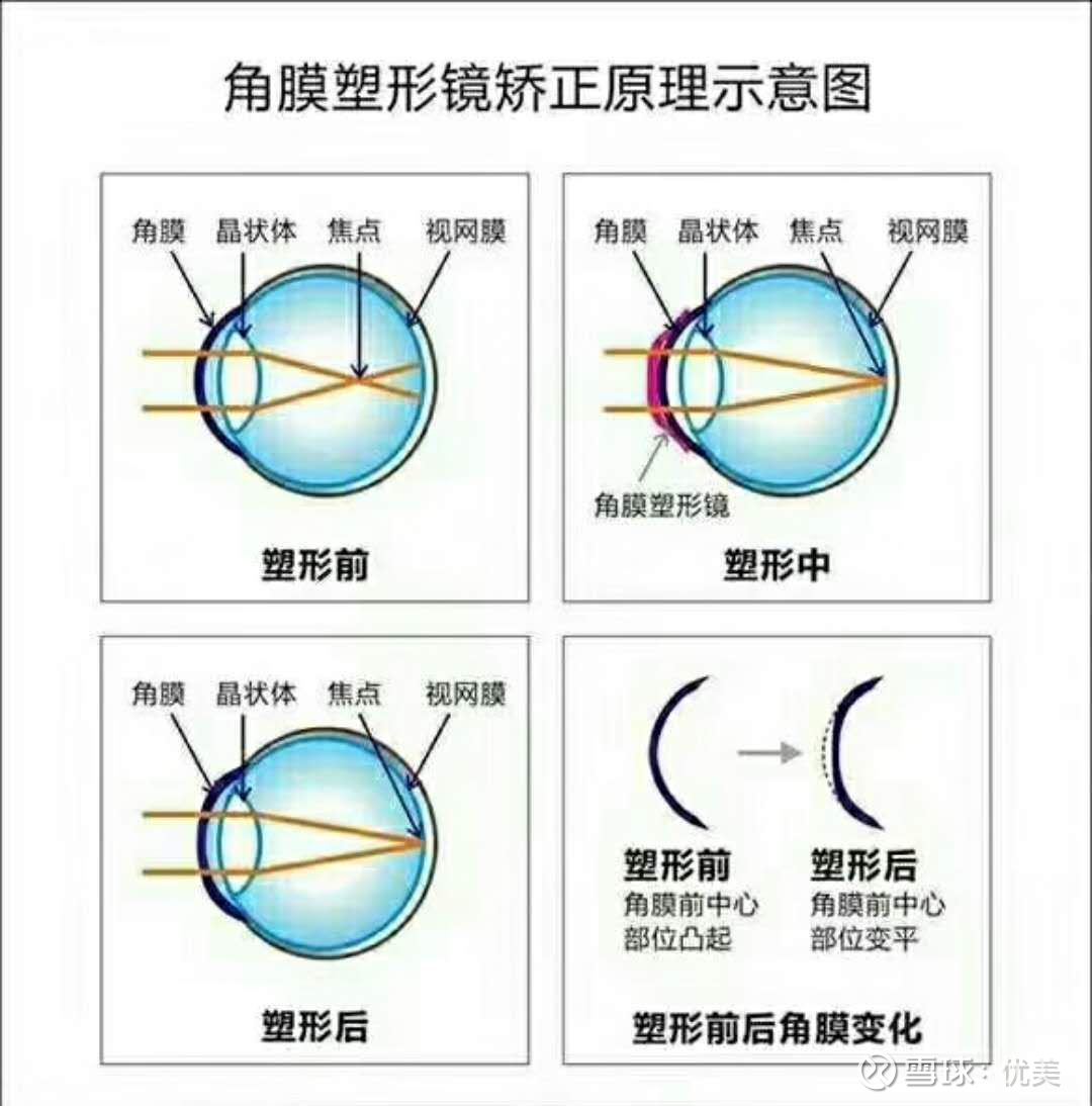 养娃记 控制近视的16种方法 你选哪个 点击上方关注 看 理财笔记 和 养娃记 养娃记 控制近视的16种方法 你选哪个 视力不佳会给生活带来很