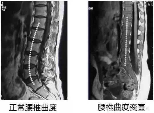 由腰椎疼痛引发十几种病变 腰椎间盘变直,反弓 腰肌乏力疼痛,性生活不