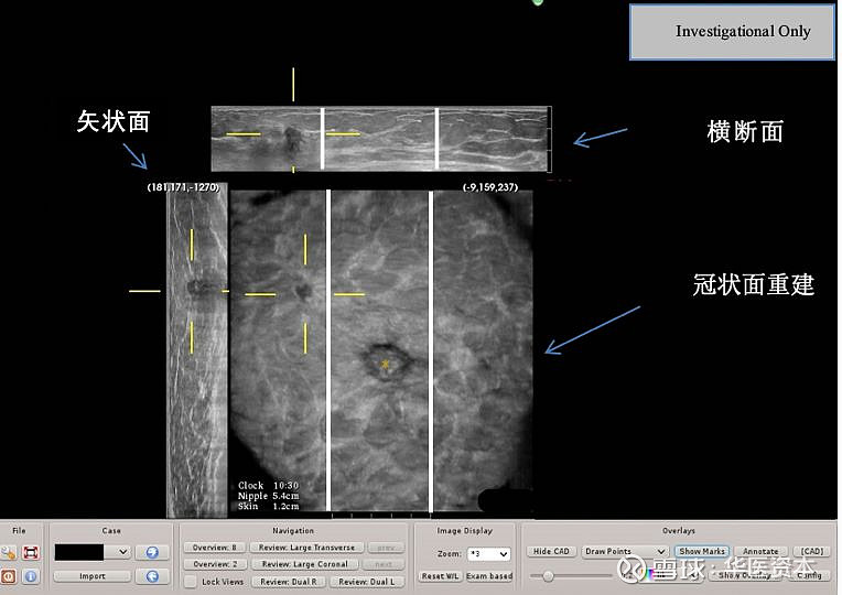 行业报告 乳腺癌早筛领域投资报告 作者：华医资本 核心要点 国内乳腺癌发病率逐年上升，死亡率从过去的增长态势到近年来持平甚至略有下降，主要得益于早筛普及和 雪球