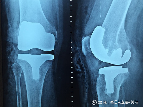 香港專科醫生預約人工膝關節置換術引入快速康復模式大幅減少住院時間