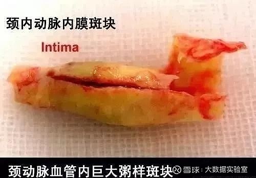 这些微生物的因素对粥样硬化斑块之间的关系不容忽视.