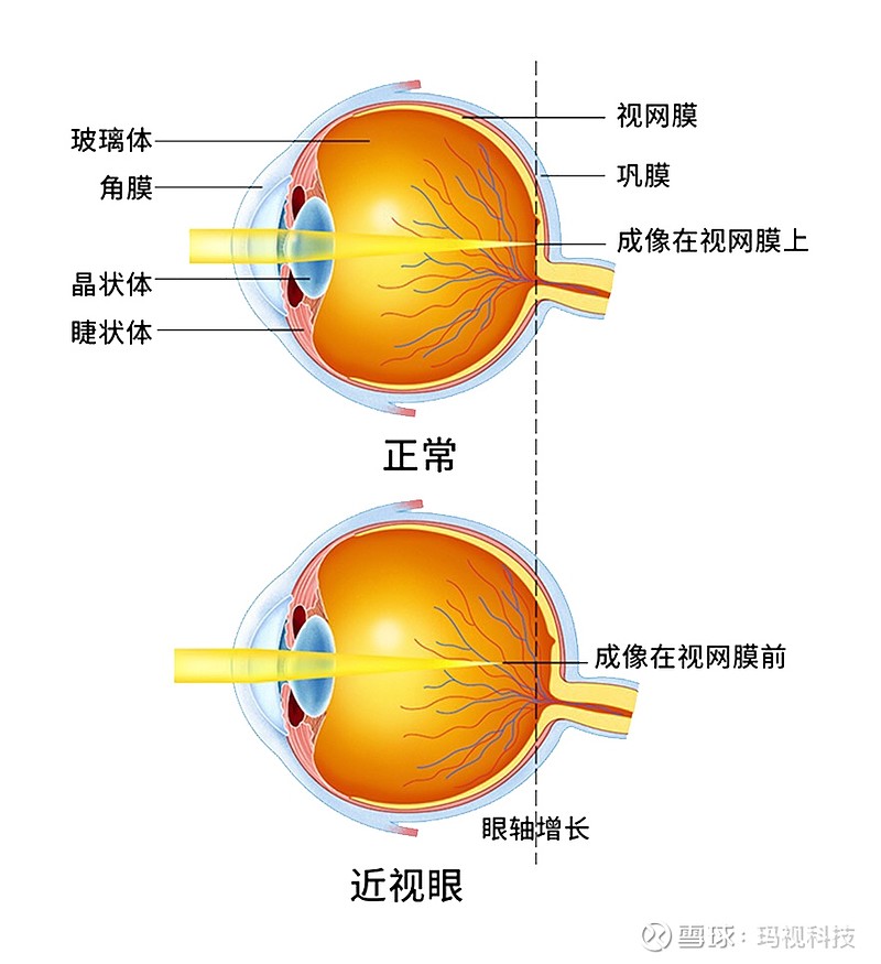 瑪視愛目鏡什麼是屈光不正