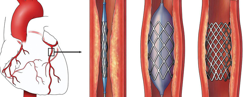 心脏支架多大尺寸图片图片