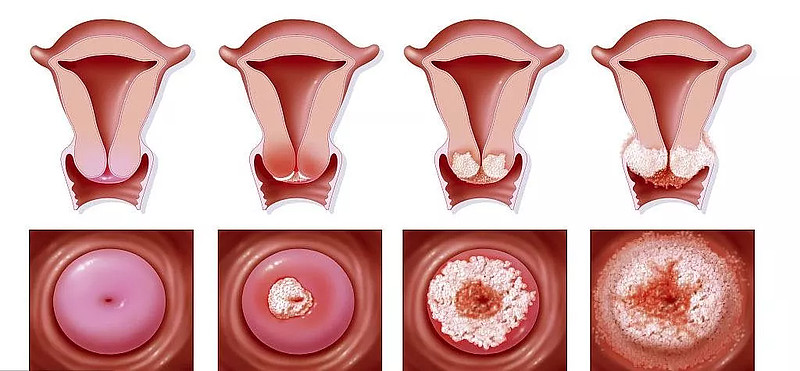 宫颈糜烂症状图片_症状宫颈糜烂图片女_宫颈糜烂的症状的照片