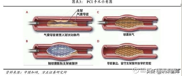 冠状动脉球囊扩张术图片