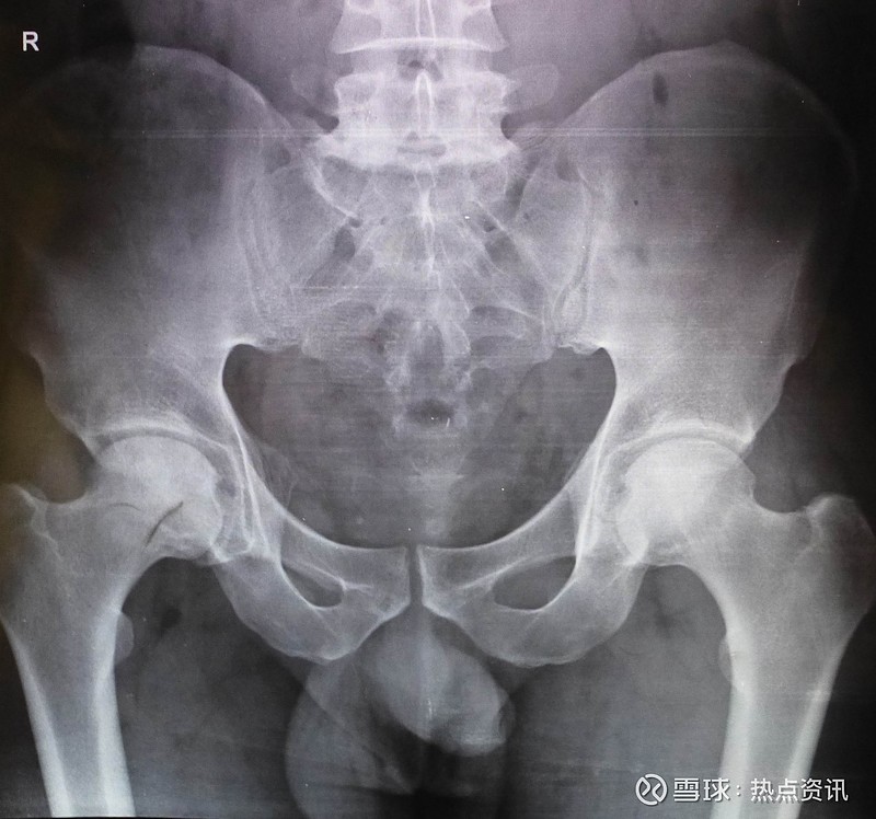 图2同一患者治疗8个月后,x线片显示右侧股骨头无菌坏死有新骨及骨小梁