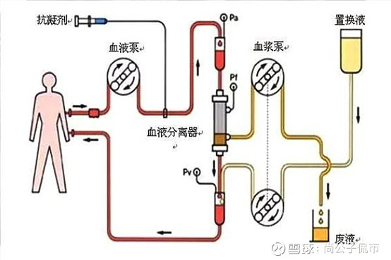 血液灌流图片示意图图片