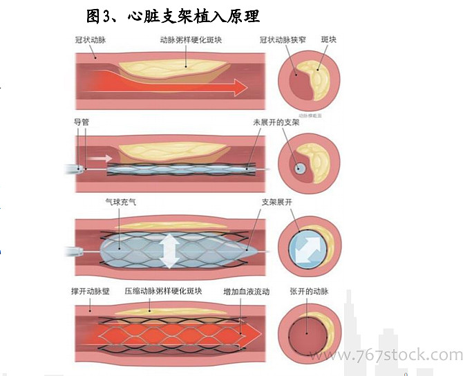 行业冠脉支架迭代中持续成长的市场69页