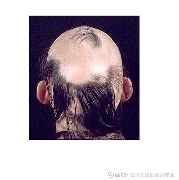 其秃发可逐渐进行或迅速发展,在几天或几个月内头发全部脱落而成全秃