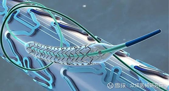 继700元冠脉支架后125元的球囊将在广东出现