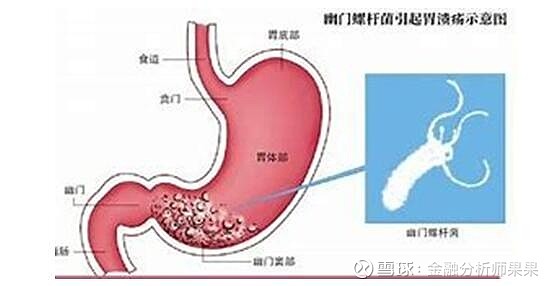 幽门螺杆菌 病理学词典 Mypathologyreport Ca