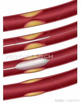 球囊扩张术血管图片