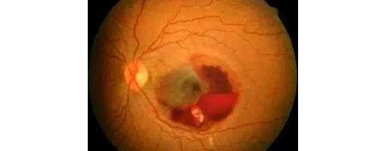 康弘药业等待15年的突破 双特异性抗体革新眼科anti Vegf疗法 每4个月注射1次 Sz 乌龟量化