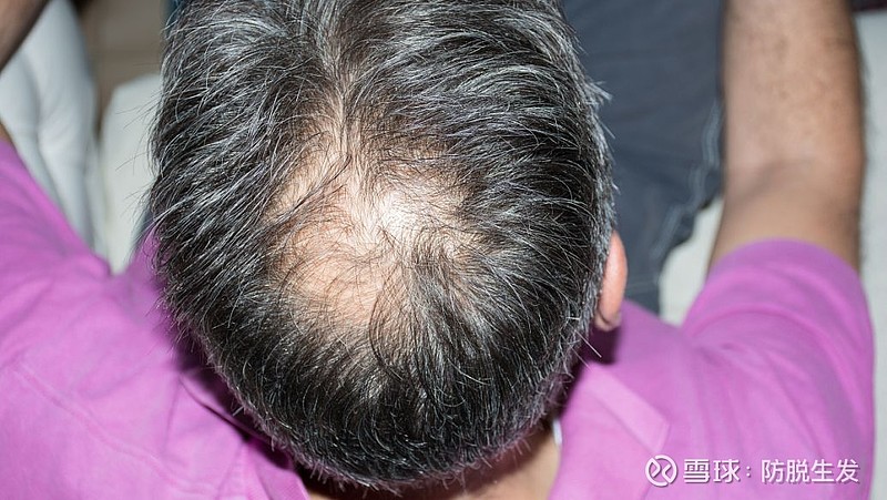 脂溢性脱发吃什么药可以生发