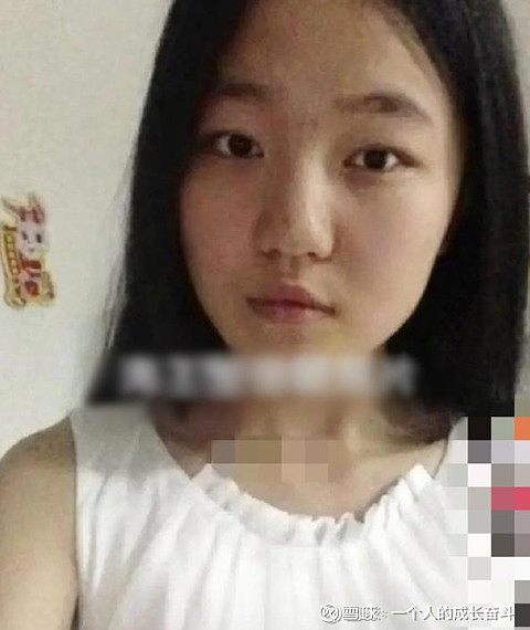 爱美客 ,华熙生物,昊海生科,华东医海后网红项思醒的照片前后对比告诉