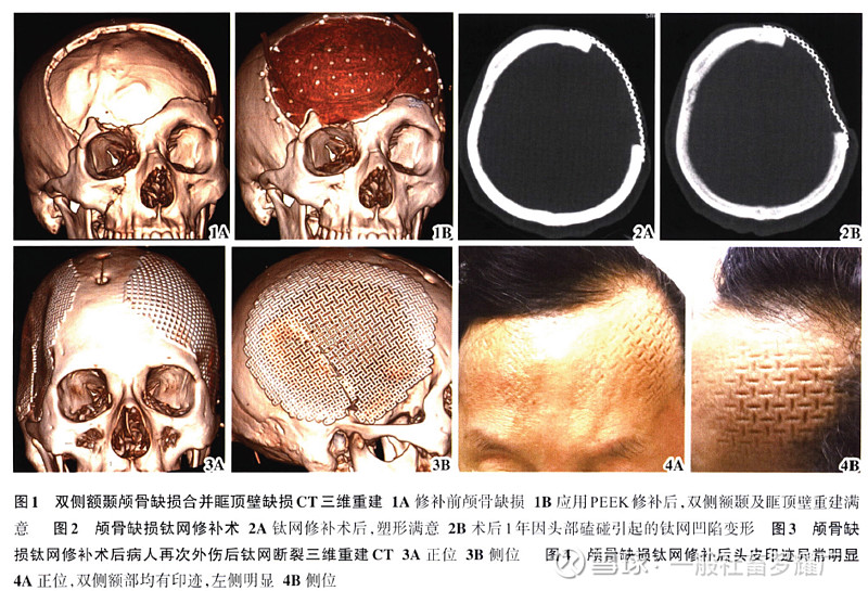 $康拓醫療(sh688314)$ 顱骨 鈦網修補 vs peek修補,價格的區別↓ 效果