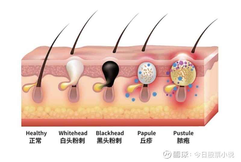 是皮肤分泌的皮脂,脱落的角质,微生物及其代谢物在毛孔中形成的角栓