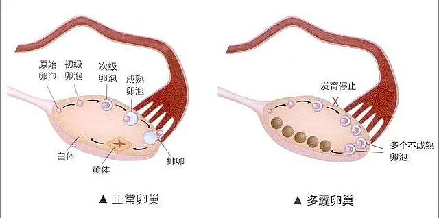 多囊卵巢真实图片图片