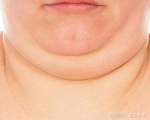 比较典型的就是弓背久坐,脖子前伸或睡觉枕头过高等导致下巴低于水平
