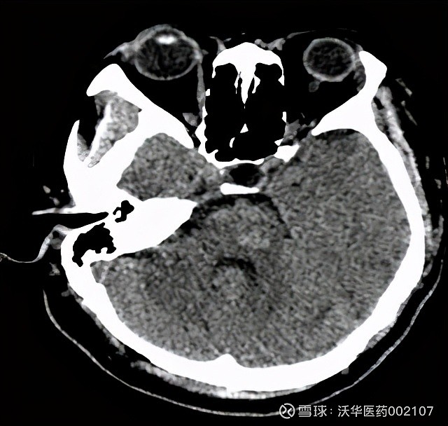 脑干出血的ct片子图片图片